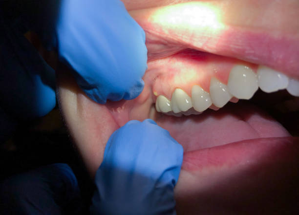 Best Emergency Tooth Extraction  in Brook Highland, AL